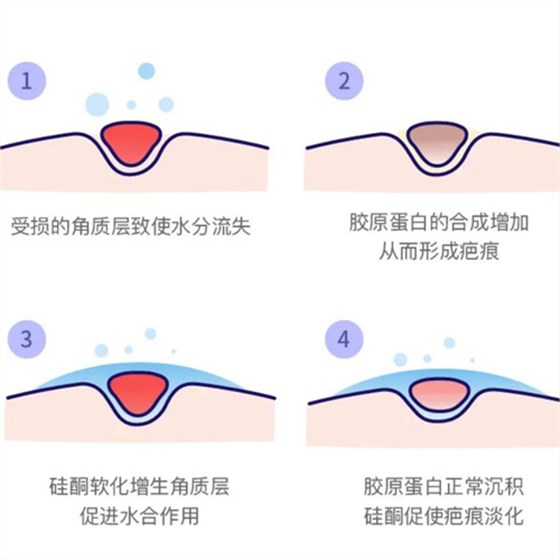 疤痕贴20210625